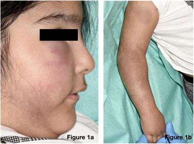 Case Report: Generalised Panniculitis as a Post-COVID-19 Presentation in Aicardi-Goutières Syndrome Treated With Ruxolitinib